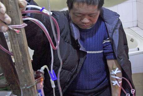 ademin-blog.blogspot.com - Wow, Pria China Bertahan Hidup 13 Tahun Berkat Alat Cuci Darah Buatan Sendiri