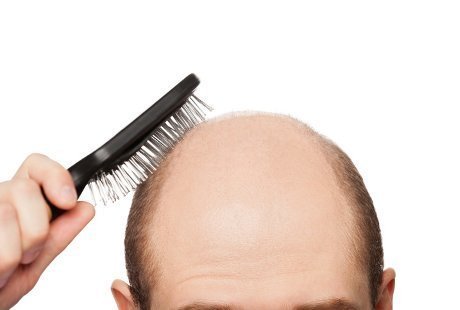 Men who bald-headed, more at risk exposed to heart disease