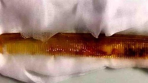 Astaga! Sisir Tertelan Saat Digunakan untuk Dorong Obat ke Tenggorokan