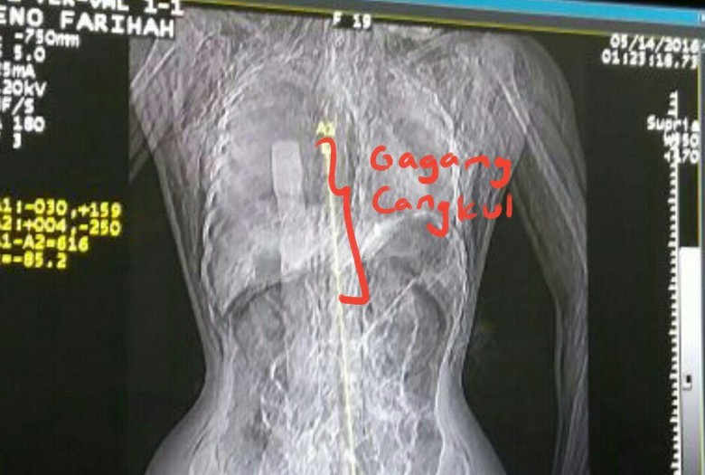 Ini Hasil Rontgen Gagang Cangkul di Tubuh Eno Korban Pembunuhan Sadis