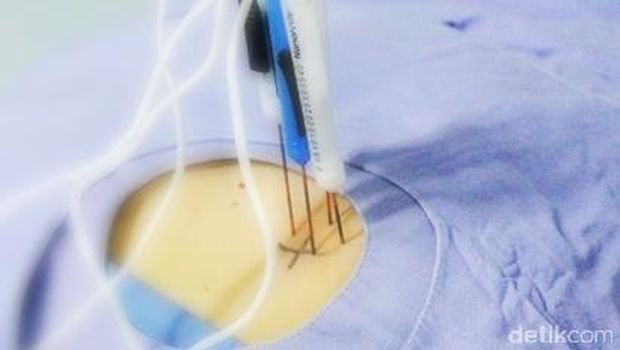 Begini Nih Cara Kerja Cryosurgery untuk Membunuh Kanker Begini Nih Cara Kerja Cryosurgery untuk Membunuh Kanker