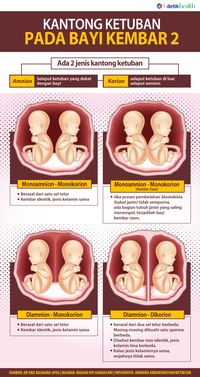 Infografis: Macam-macam Kondisi Kantong Ketuban Bayi Kembar Dua
