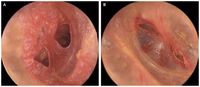 Gendang telinga sang pria yang pecah. (Foto: The New England Journal of Medicine)