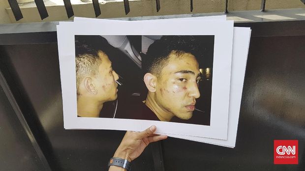 Wajah Axel yang babak belur setelah dipukuli oknum.