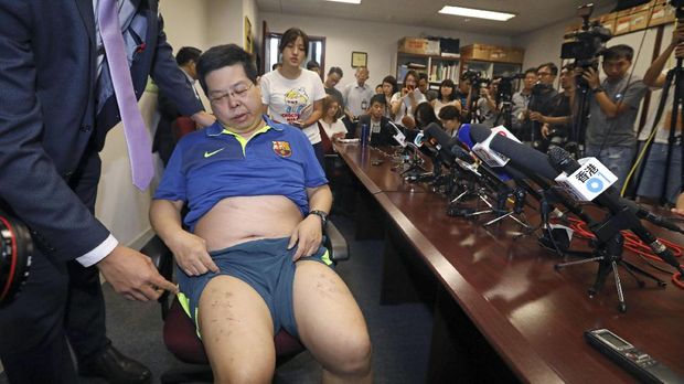 Howard Lam memperlihatkan luka-luka yang disebutnya akibat pemukulan oleh agen rahasia China.