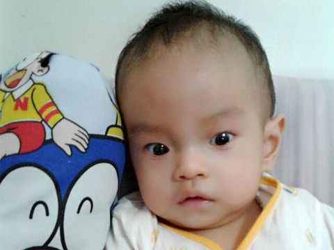 Abyn kena katarak sejak bayi/