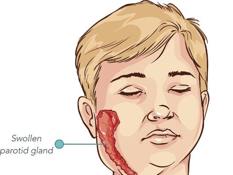 Ilustrasi gondongan/