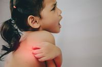 Fakta-fakta Alergi pada Anak yang Bunda Perlu Tahu