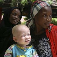 Penyebab Anak Lahir Albino Penyebab Anak Lahir Albino