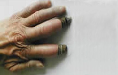 Gangrene Gangrene
