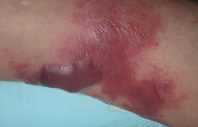 Septicemia Septicemia
