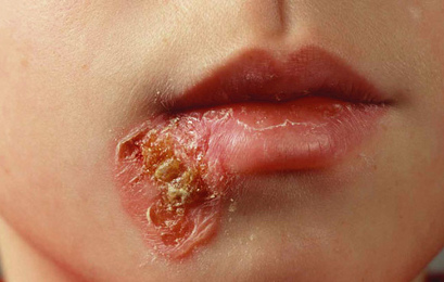 Impetigo Impetigo