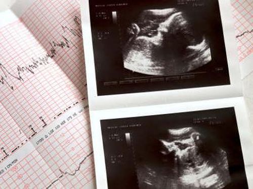 Jumlah Bayi Kembar yang Lahir Tak Sesuai Hasil USG? Ini Jumlah Bayi Kembar yang Lahir Tak Sesuai Hasil USG? Ini