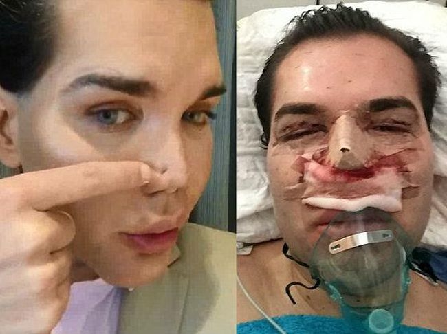 Terobsesi Mirip Ken 'Barbie', Hidung Pria Ini Membusuk 