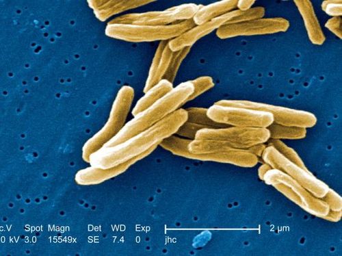 Ketahui Penyebaran Si Kuman Udara Penyebab Tuberkulosis Ketahui Penyebaran Si Kuman Udara Penyebab Tuberkulosis