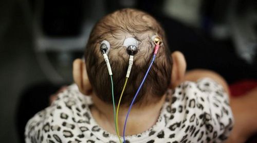 Infeksi Zika Sebabkan 1 dari 10 Anak Lahir dengan Kelainan Bawaan Infeksi Zika Sebabkan 1 dari 10 Anak Lahir dengan Kelainan Bawaan