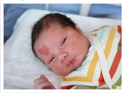 Cute! Bayi Ini Punya Tanda Lahir Berbentuk Hati di Dahinya Cute! Bayi Ini Punya Tanda Lahir Berbentuk Hati di Dahinya