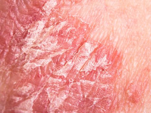 5 Fakta Psoriasis, Kondisi Kulit yang Diidap Indadari 1 5 Fakta Psoriasis, Kondisi Kulit yang Diidap Indadari 1