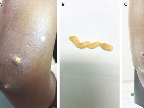 Kulit Melepuh, Ternyata karena Ada Larva Serangga