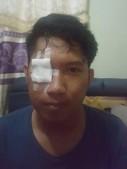 Cerita Viral Pria yang Matanya Kena Bara Rokok Saat Bermotor Cerita Viral Pria yang Matanya Kena Bara Rokok Saat Bermotor