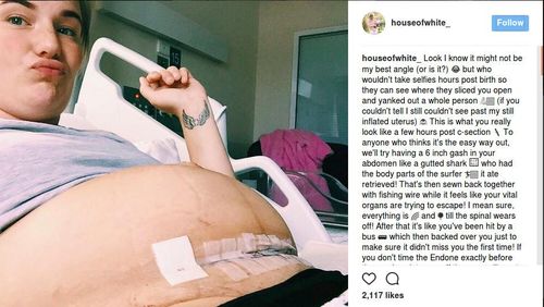 Lewat Foto, Ibu Ini Tunjukkan Perjuangan Jalani Operasi Caesar Lewat Foto, Ibu Ini Tunjukkan Perjuangan Jalani Operasi Caesar