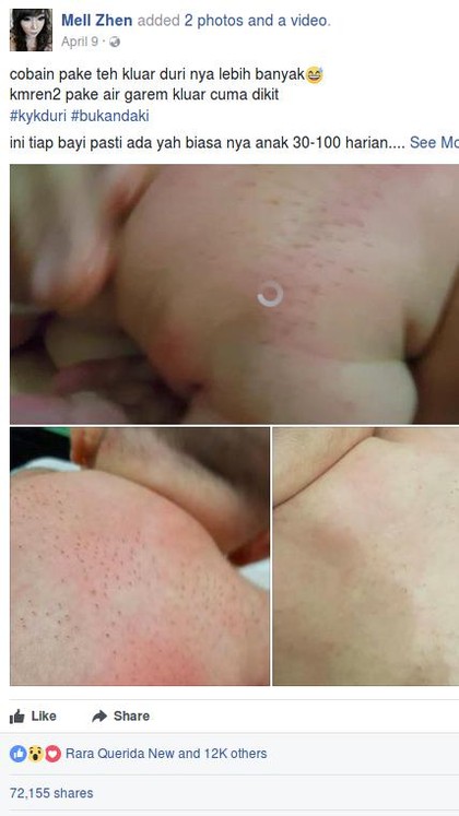 Kata Dokter Soal Video Keluar Duri dari Punggung Bayi yang Viral Kata Dokter Soal Video Keluar Duri dari Punggung Bayi yang Viral