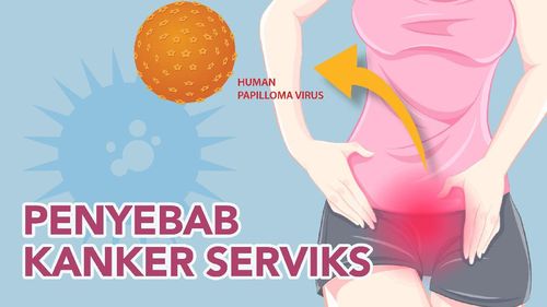 Catat! Ini yang Harus Disiapkan Sebelum Melakukan Pap Smear