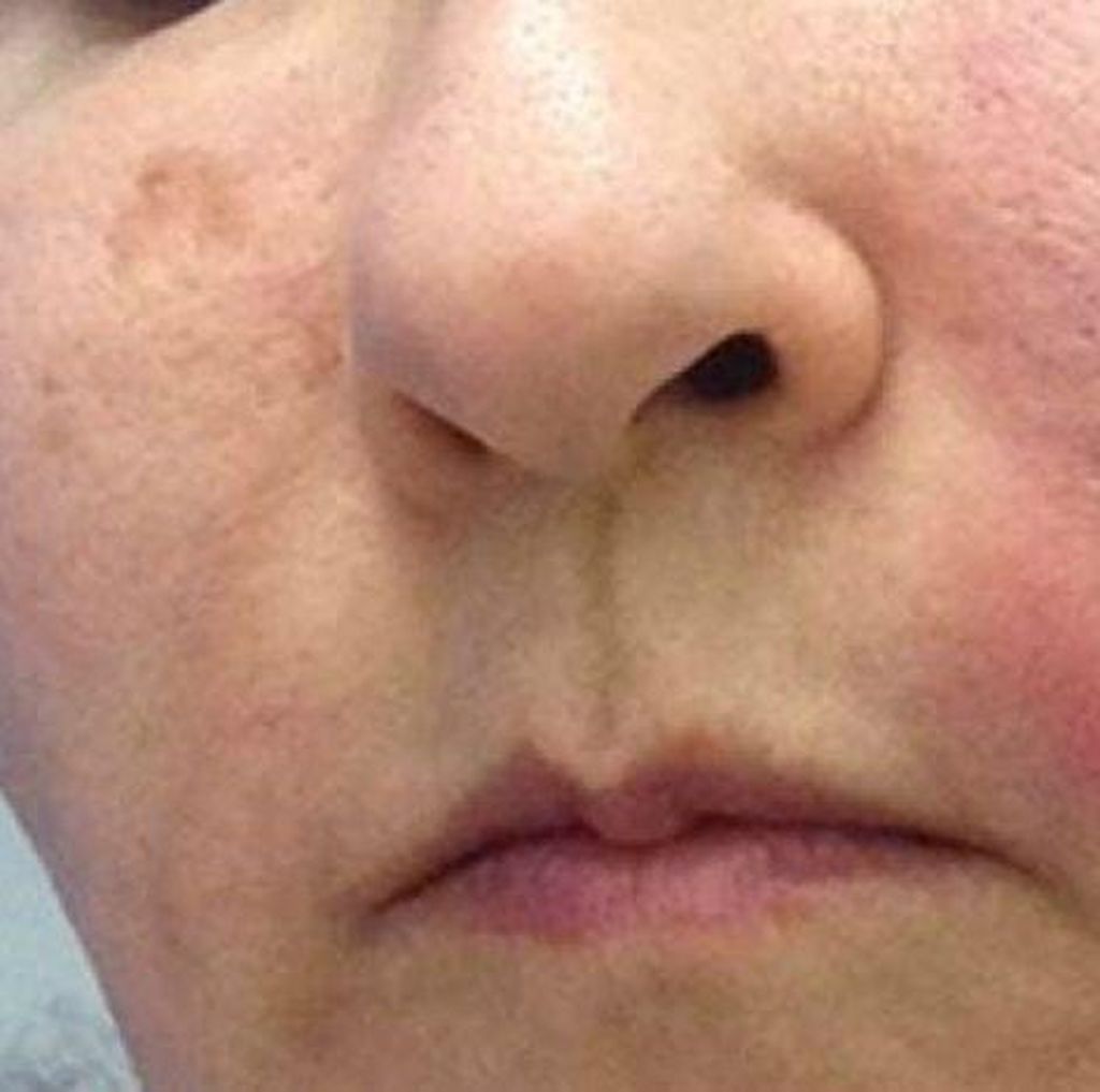 Coba Facial Vampir, Wajah Wanita Ini Malah Bengkak Kena Infeksi Coba Facial Vampir, Wajah Wanita Ini Malah Bengkak Kena Infeksi